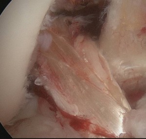 Primärversorgung mit 4-fach Semitendinosus-Transplantat